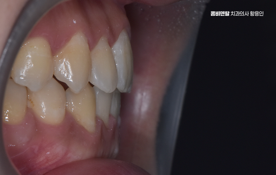 클리피씨교정 장단점 어떻게 비교하면 될까요 관련 이미지 7