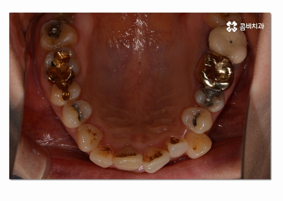 3급 부정교합 지금이라도 고치고 싶다면 관련 이미지 4