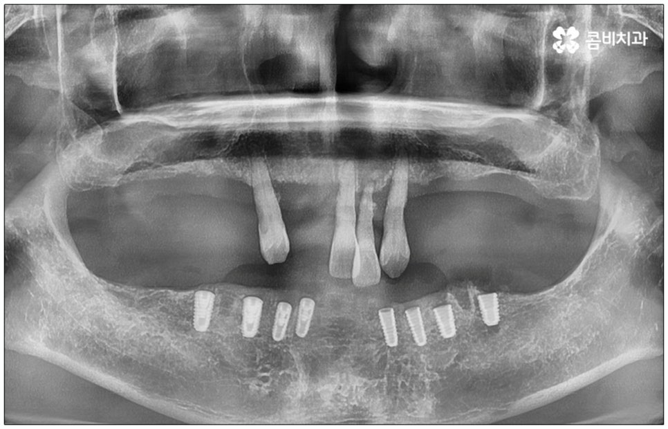 노인임플란트 참고사항 알아봐요 관련 이미지 8