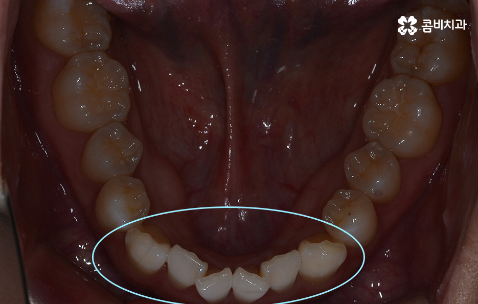비발치치아교정 고민되는데 발치하면 안좋나요 관련 이미지 8