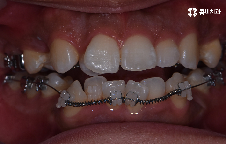 덧니 발치 교정 현명하게 선택하려면 관련 이미지 8