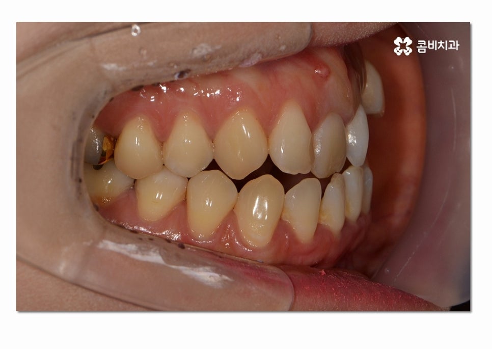 3급 부정교합 지금이라도 고치고 싶다면 관련 이미지 2