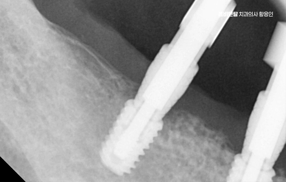 치아 발치 후 임플란트 언제부터 준비할까 관련 이미지 7