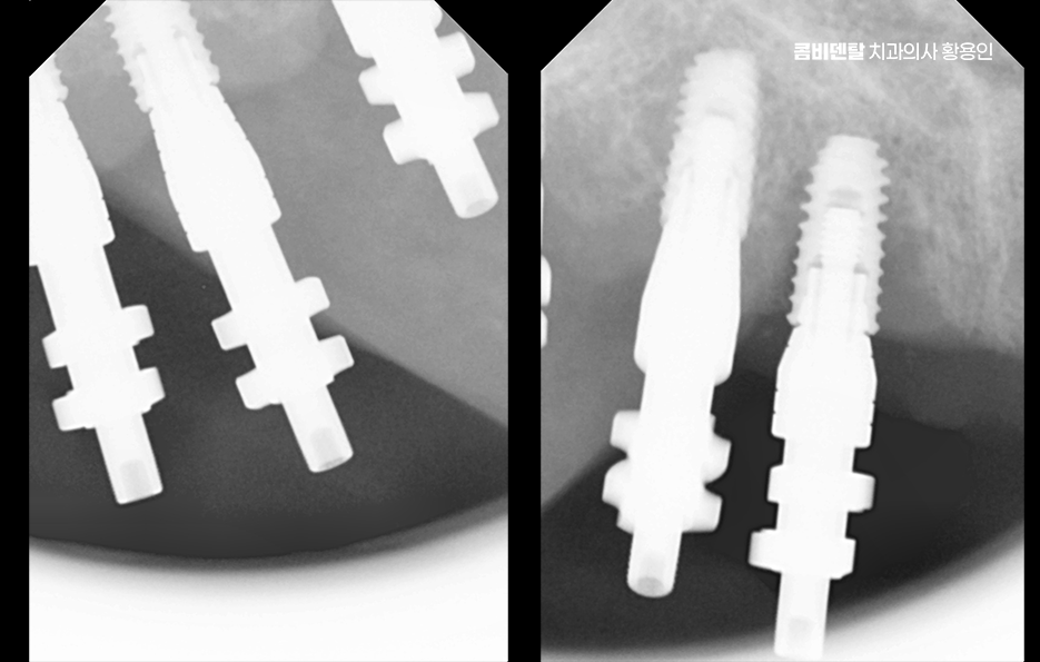 If You’re Considering Full Upper-Arch Implants for the Long Term image 6