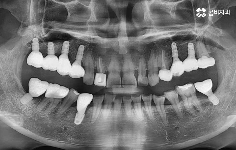 임플란트 치료기간 어느정도 걸리고 치과에는 몇번 가나요 관련 이미지 14