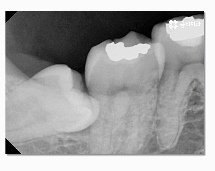 부분매복사랑니 언제 뽑아야 할까 관련 이미지 4