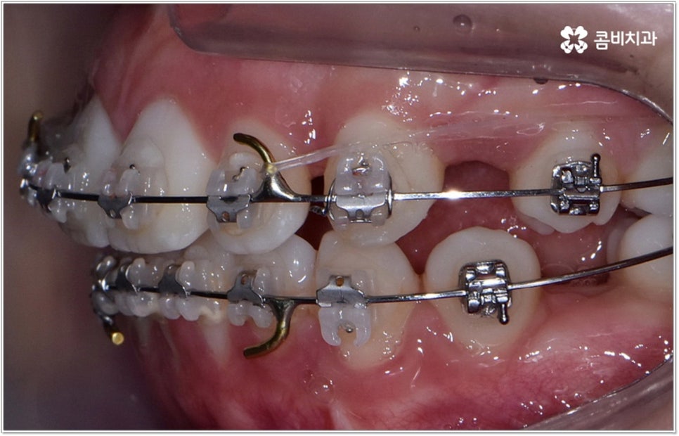 돌출입치아교정 언제가 적기인가요? 관련 이미지 8