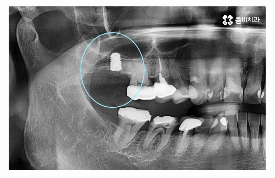 임플란트수술 제대로 알고 선택하려면 관련 이미지 5