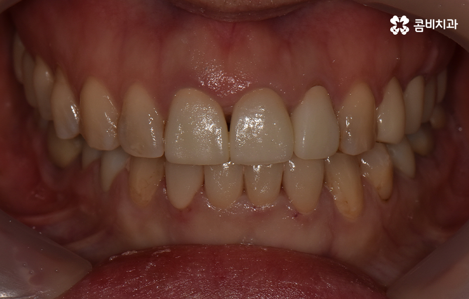 아래 앞니깨짐 치료 감쪽같이 해결하려면 관련 이미지 8
