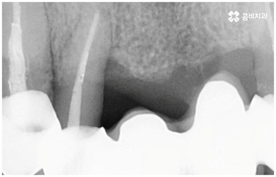 임플란트수명 연장하려면? 관련 이미지 7