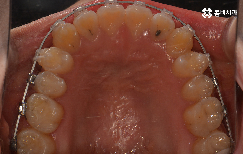 송곳니 덧니 뽑지 않고 해결된 사례 관련 이미지 5