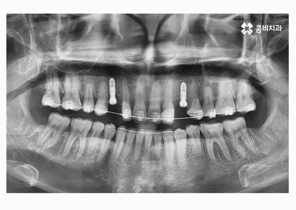 30대임플란트 향후 미래를 바라본다면 관련 이미지 8