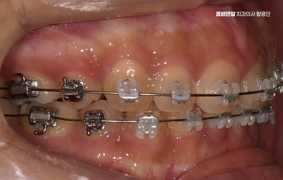 과개교합 교정 후 얼굴형 얼마나 바뀌나요 관련 이미지 7