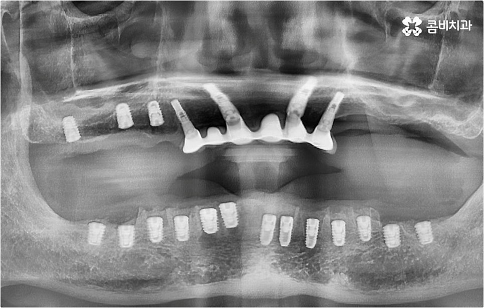 전악임플란트 고려할 사항들은 관련 이미지 12