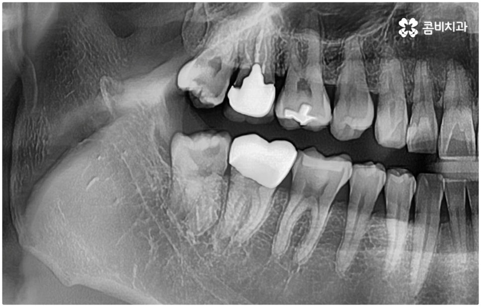 매복사랑니발치치과 어디로 가나요? 관련 이미지 2