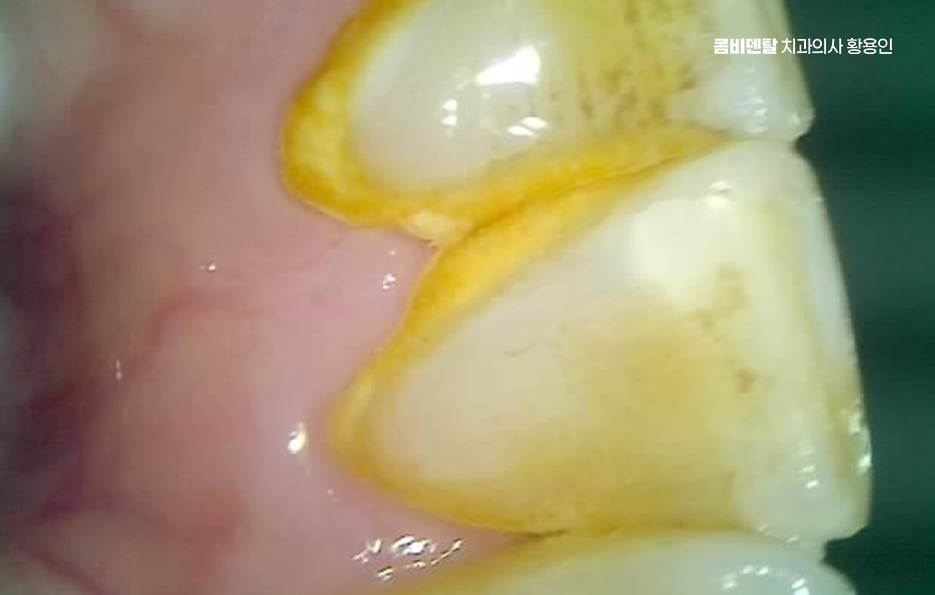 치경부마모증 치료 과정 신중하게 준비하려면 관련 이미지 3