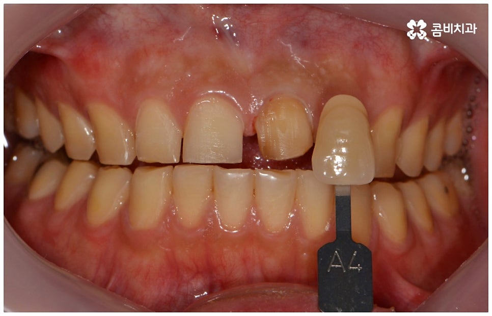앞니충치치료 어떻게 이뤄지나요 관련 이미지 10