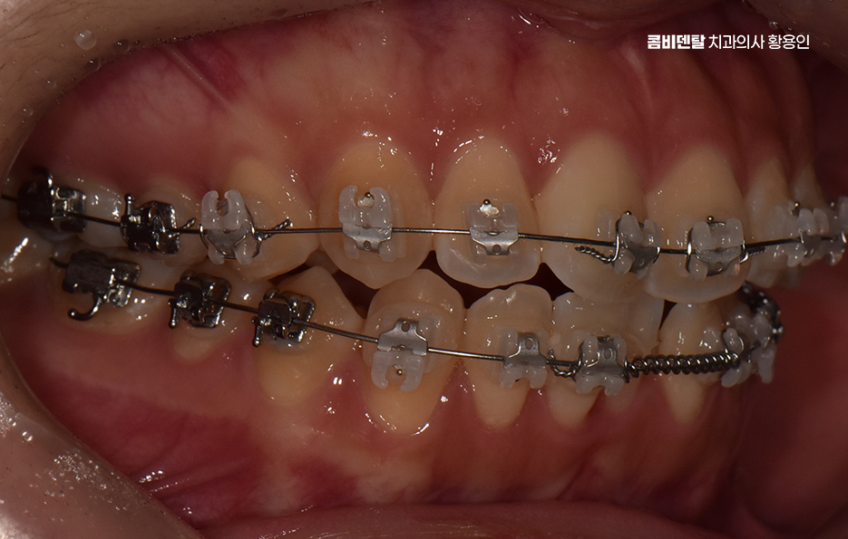 How Can You Determine the Duration of Front Teeth Orthodontic Treatment? image 8