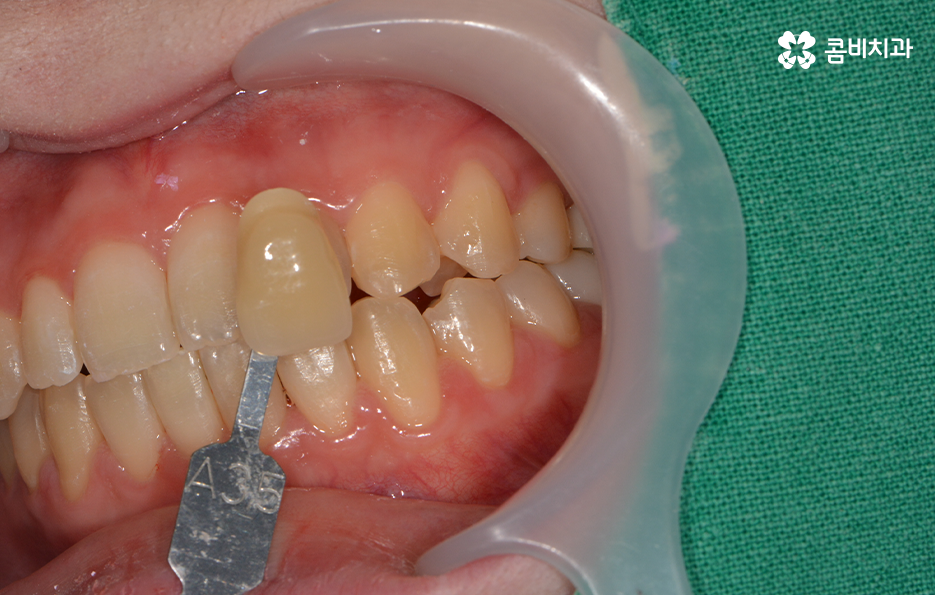 치과치아미백 어떻게 다른지 설명해드려요 관련 이미지 2