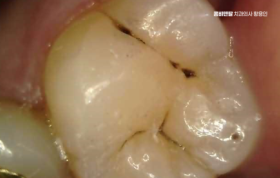 충치 치아 깨짐 시점이 관건이라면 관련 이미지 7
