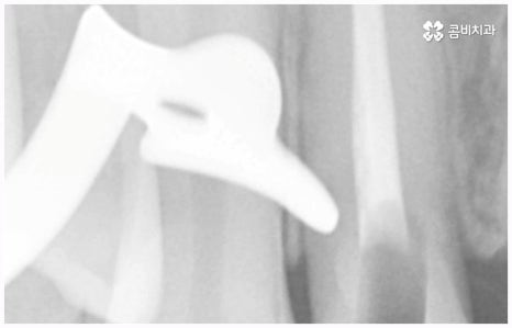 임플란트 종류 어떤게 맞을까요? 관련 이미지 4