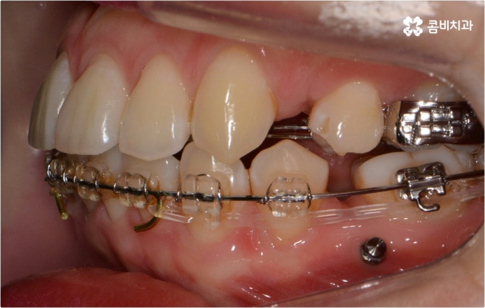 돌출입 치아교정 부모와 아이가 함께 알아봐요 관련 이미지 8