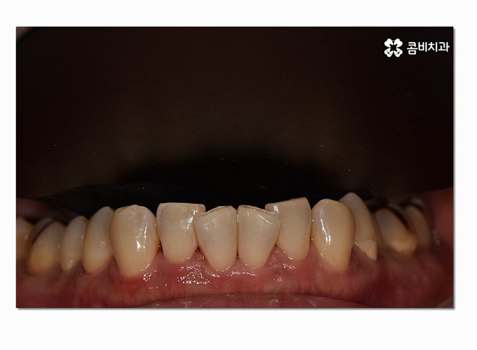 치아라미네이트 누구에게 필요할지 궁금하다면 관련 이미지 3