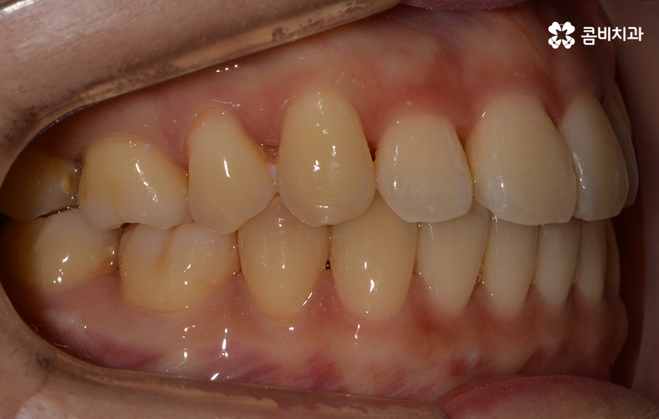 앞니치아교정 자연스러운 결과를 위해 알아둬야 할 점 관련 이미지 11