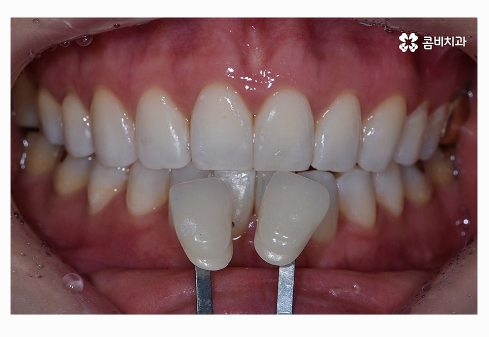 누런이로 고민하시는 분들을 위한 치아미백 정보 관련 이미지 8