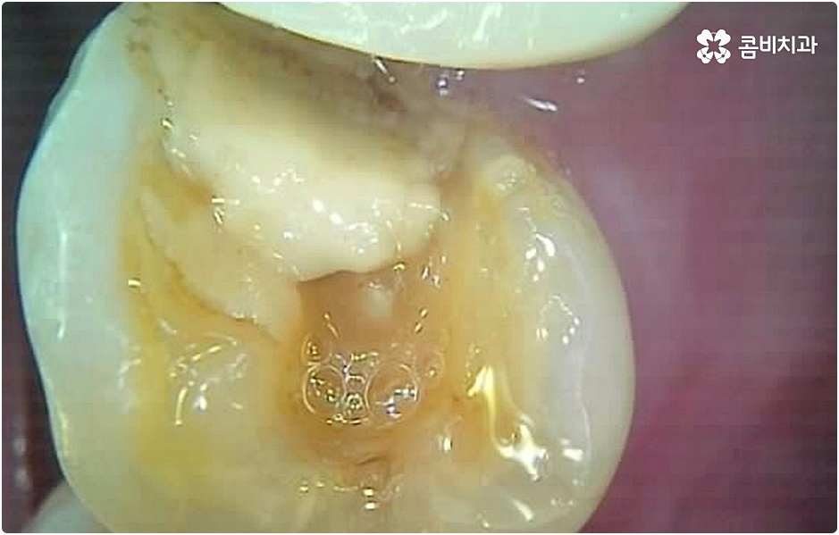 20대임플란트 남의일이 아니라면 관련 이미지 12