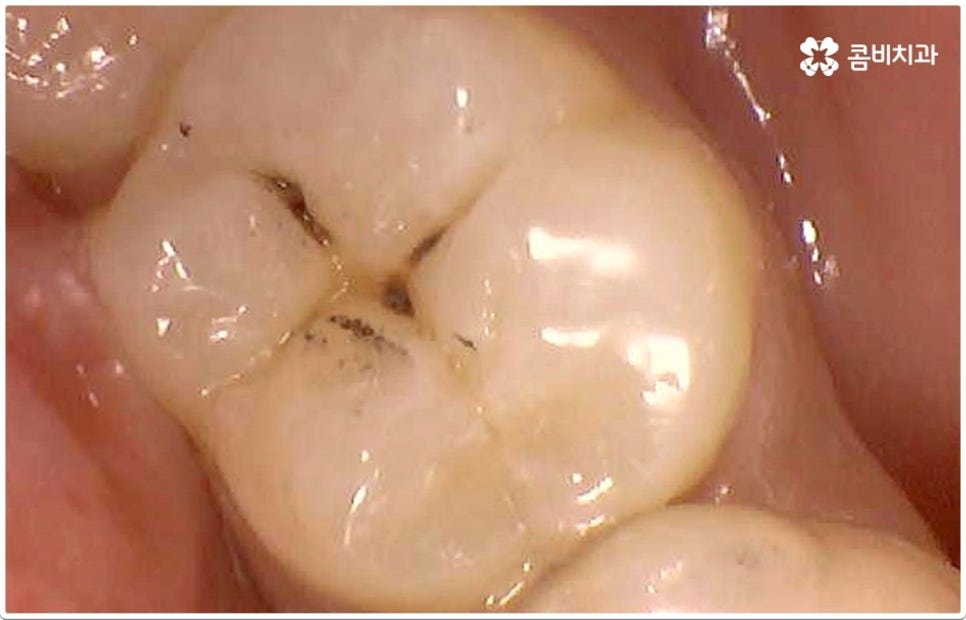 치아사이충치 놔두면 안돼요 관련 이미지 5