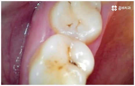 임플란트 종류 어떤게 맞을까요? 관련 이미지 13