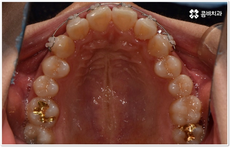 덧니부분교정 시작하려면 관련 이미지 12