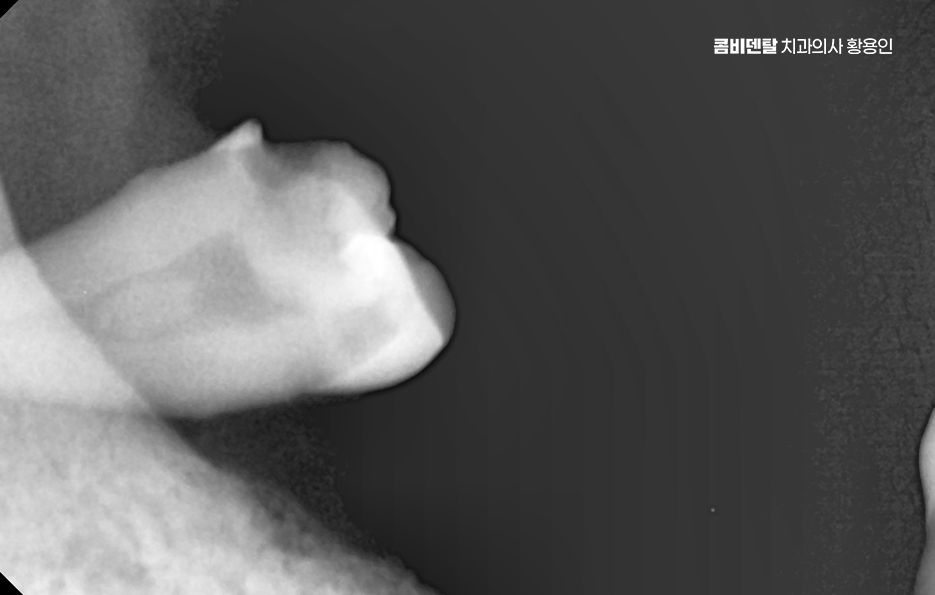 어금니 발치후 임플란트 안하면 어떻게 변하는걸까 관련 이미지 3