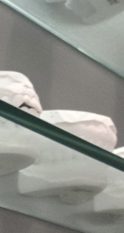 사랑니 주변 잇몸 통증 지금부터가 중요하니까 관련 이미지 19