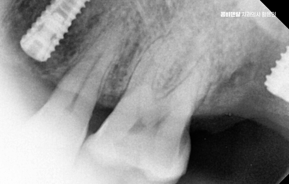 어금니 없으면 얼굴 발음에 어느정도나 안좋을까 관련 이미지 10