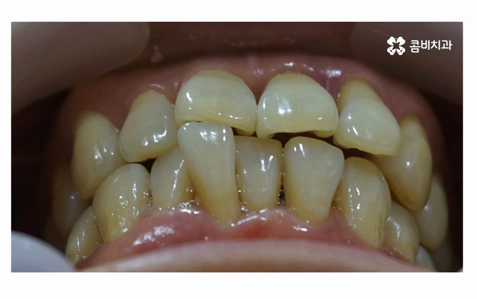 어금니 발치 심각해지기 전에 막으려면 관련 이미지 3