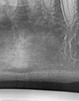어금니 뒤 잇몸 부음 어떤 문제길래 이런거죠 관련 이미지 43