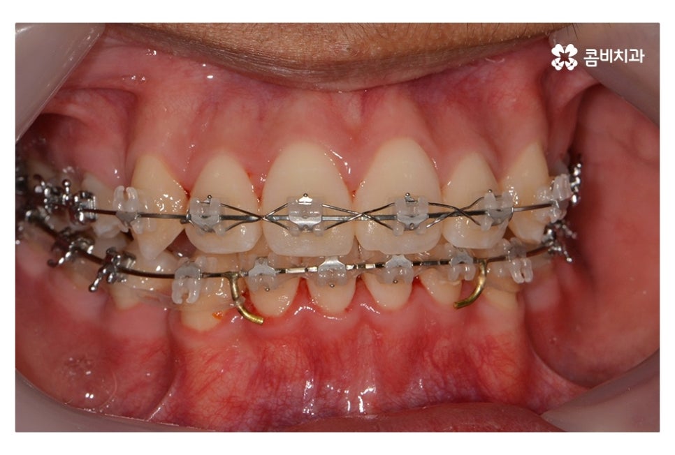 중학생치아교정 세심하게 체크하려면 관련 이미지 8