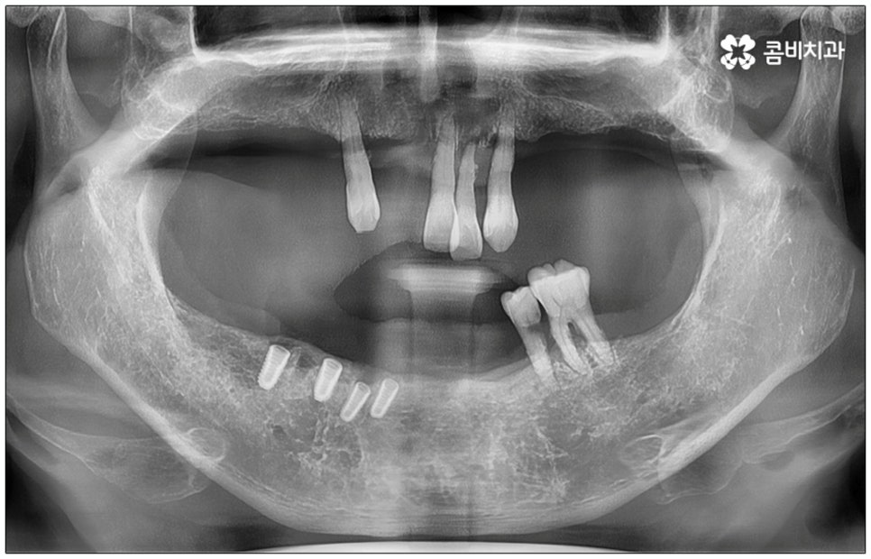 노인임플란트 참고사항 알아봐요 관련 이미지 2