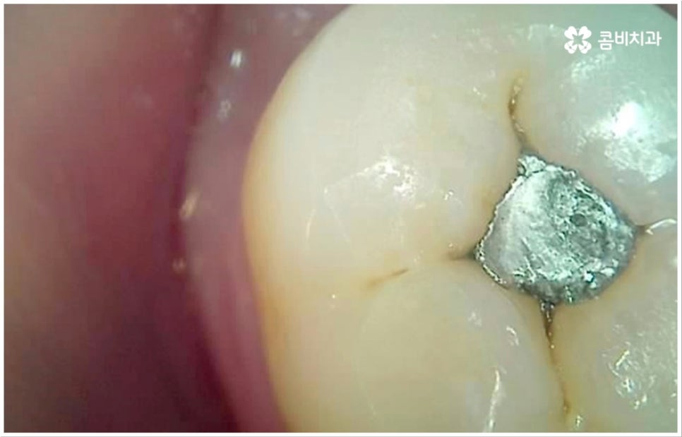 충치 통증 참지마세요 관련 이미지 7