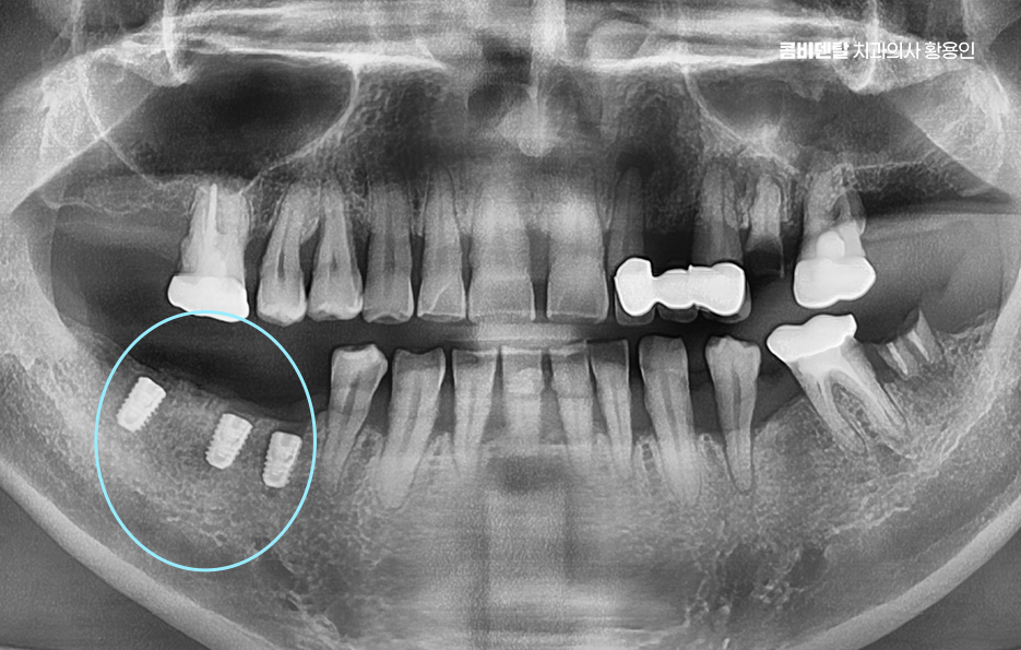 치아 발치 후 임플란트 언제부터 준비할까 관련 이미지 3