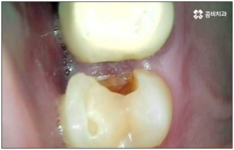 당일임플란트 나도 할수있나요 관련 이미지 6