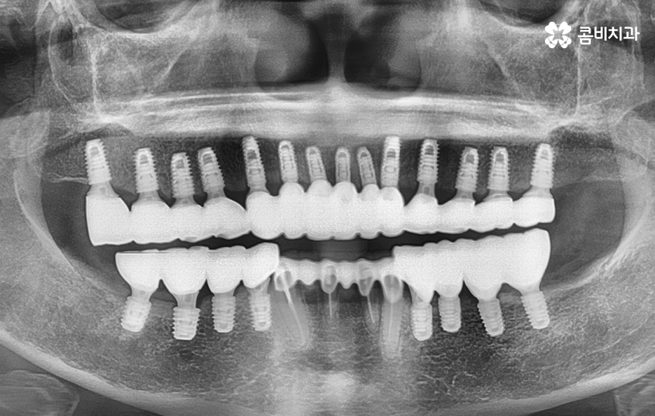 65세이상임플란트 고령이기에 간과하지 말아야 할 사항은 관련 이미지 11
