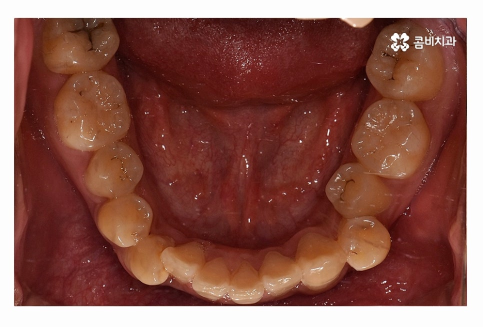 덧니 발치 필수적으로 하는건가요 관련 이미지 6