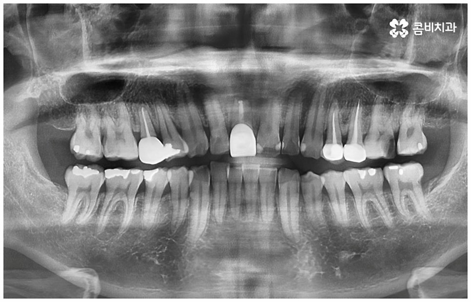 어금니신경치료 케이스마다 달라요 관련 이미지 1