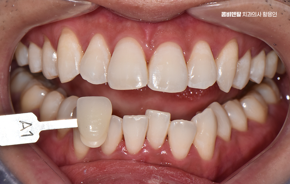 치과 치아미백 효과 어떤식으로 나타날까 관련 이미지 6