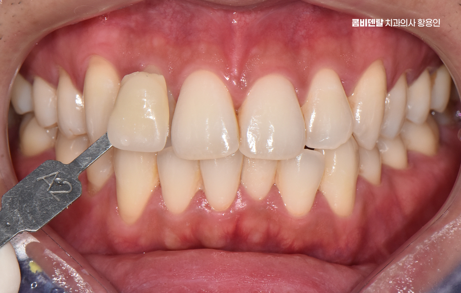 치과 치아미백 효과 어떤식으로 나타날까 관련 이미지 1