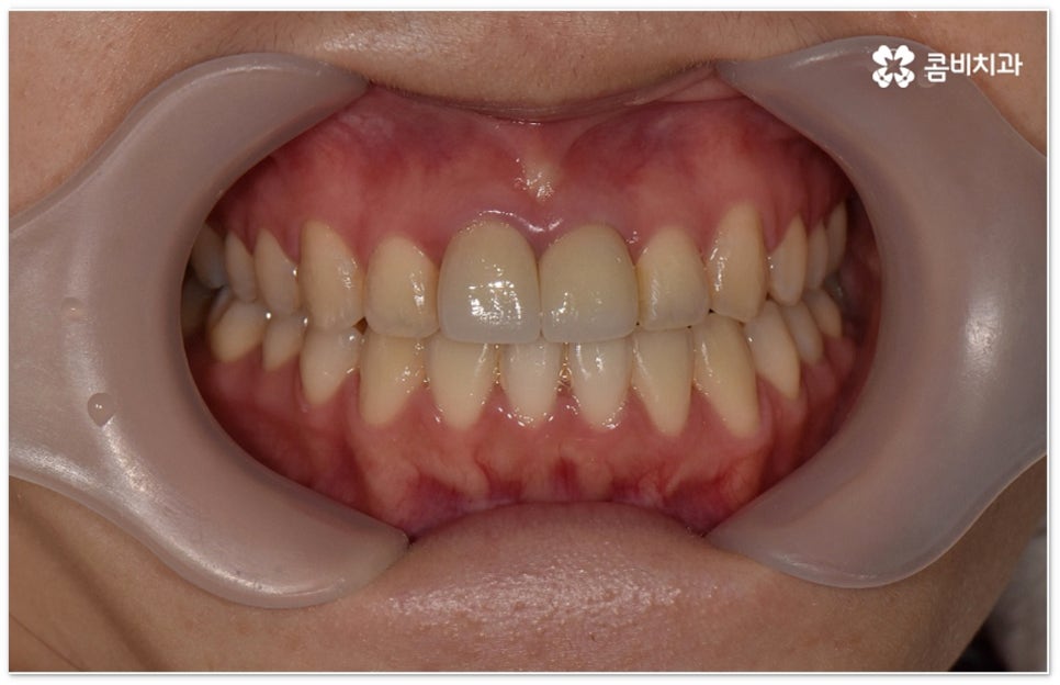 치아교정장치 어떻게 고르나요 관련 이미지 12
