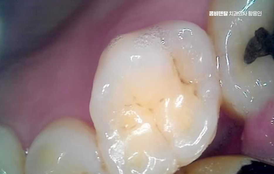 오래된 보철물 아말감 교체 어떠한 케이스일까 관련 이미지 8